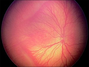 Retinopatía Del Prematuro - Oftalmolaser